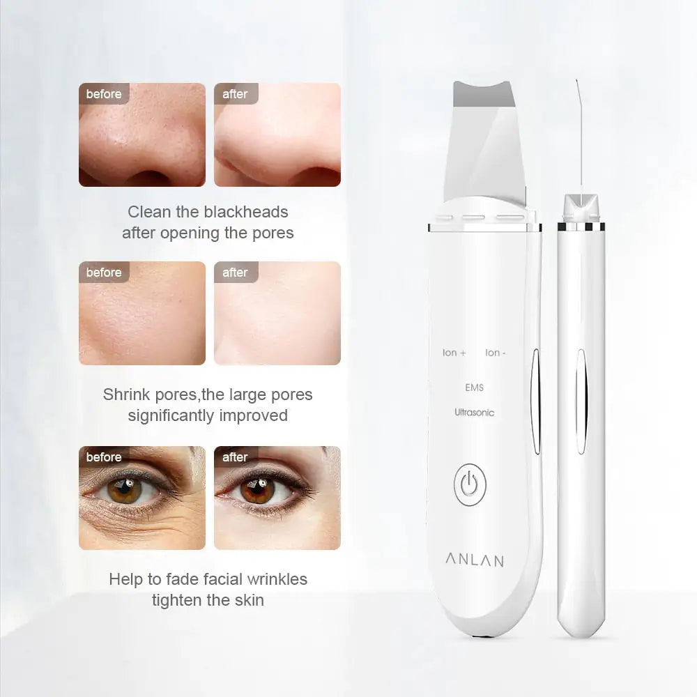 Ultrasonic Skin Scrubber